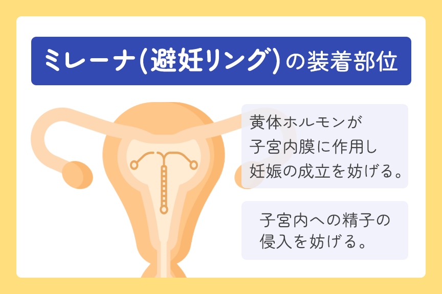 子宮内膜症や多嚢胞性卵巣症候群に最適なのはどのタイプですか?